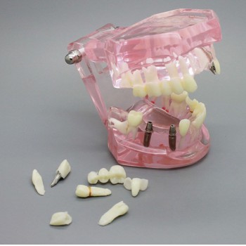 Dental Implant Study Analysis Demonstration Teeth Model with Restoration 2001 Pink
